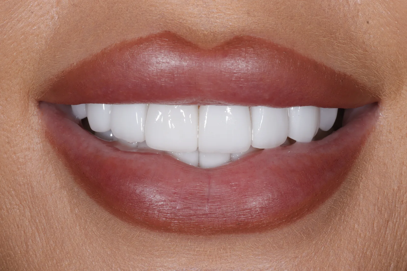 After porcelain veneers replacing stained bonding
