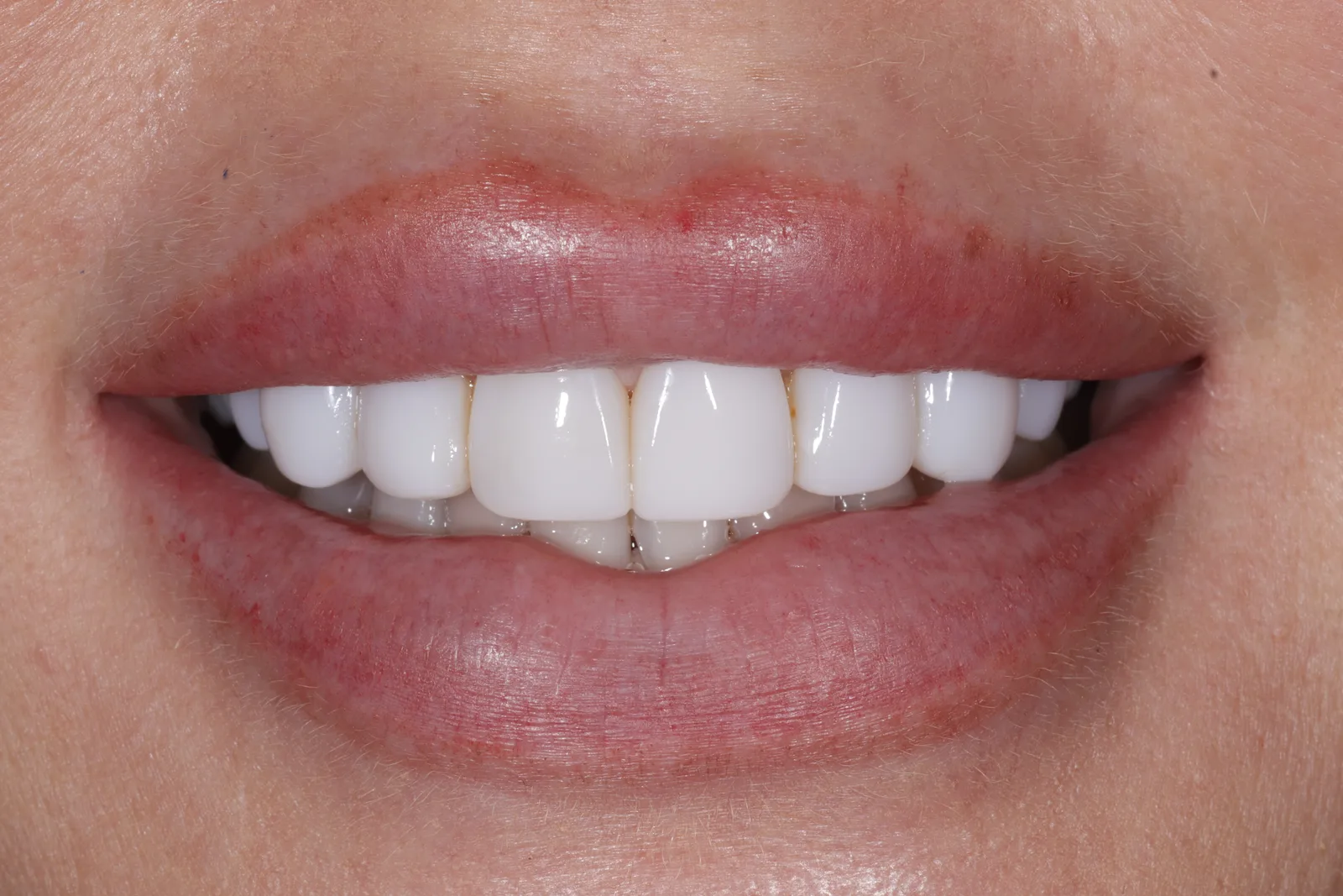 Before porcelain veneers replacing stained bonding