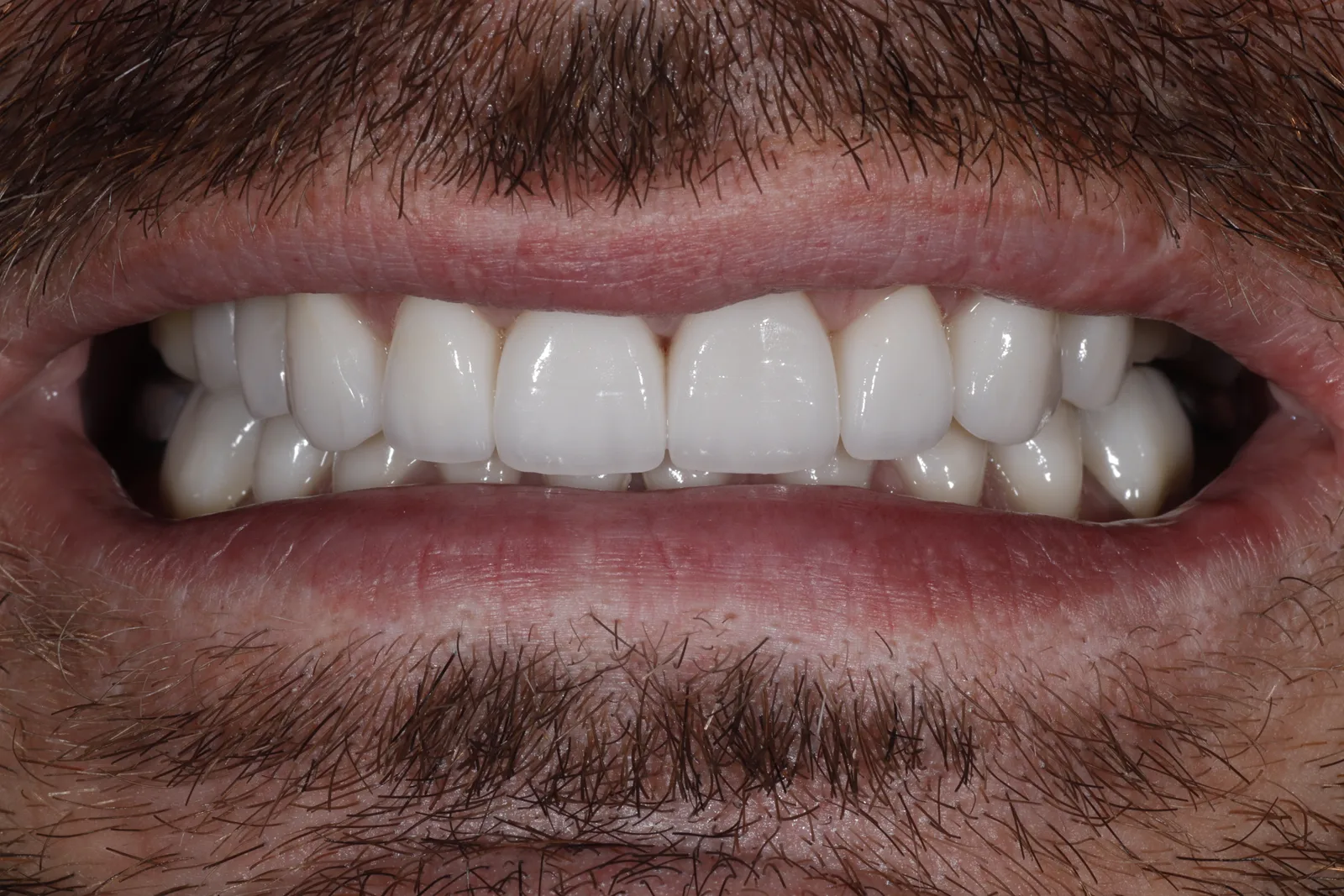 After upper and lower porcelain makeover