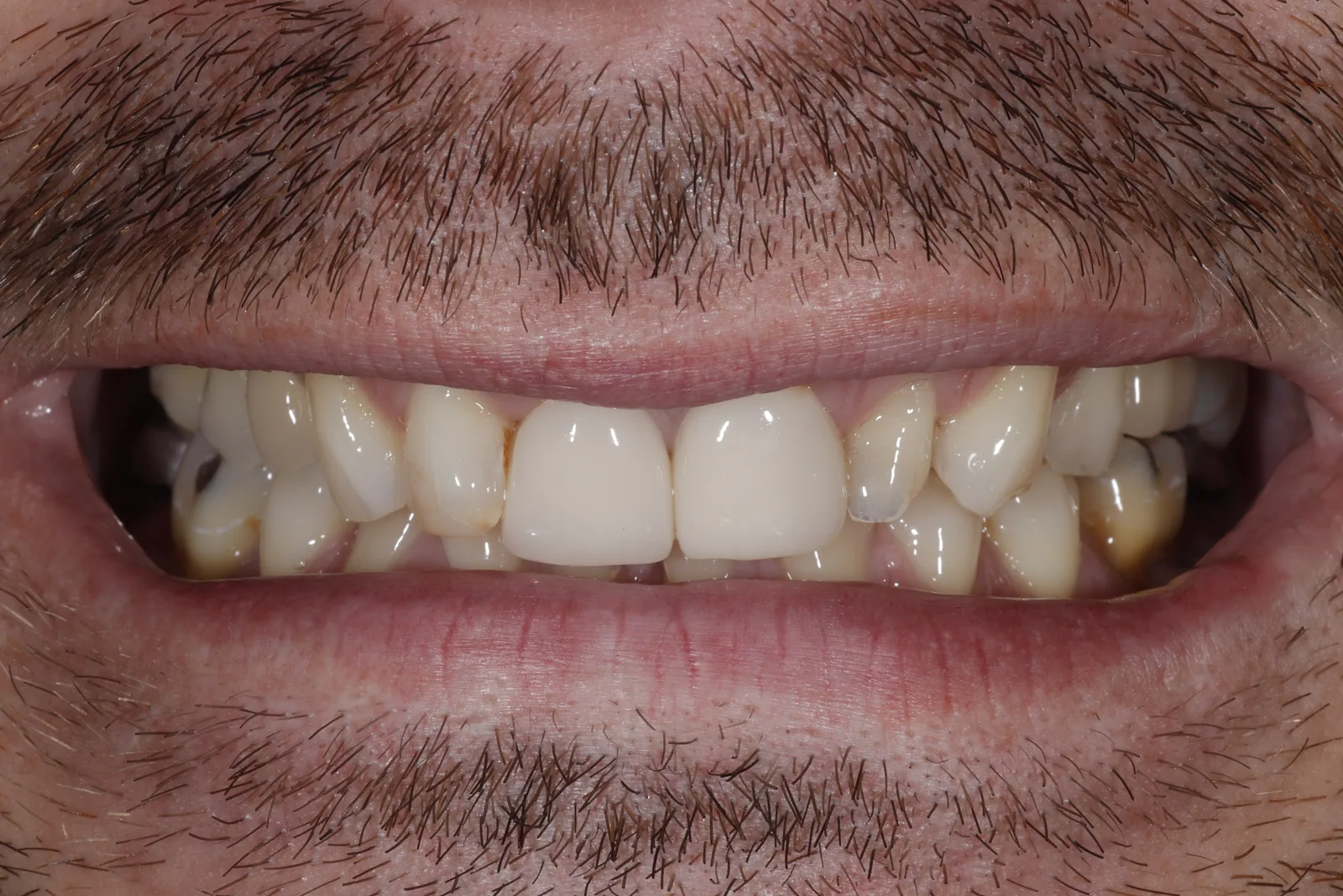 Before upper and lower porcelain makeover