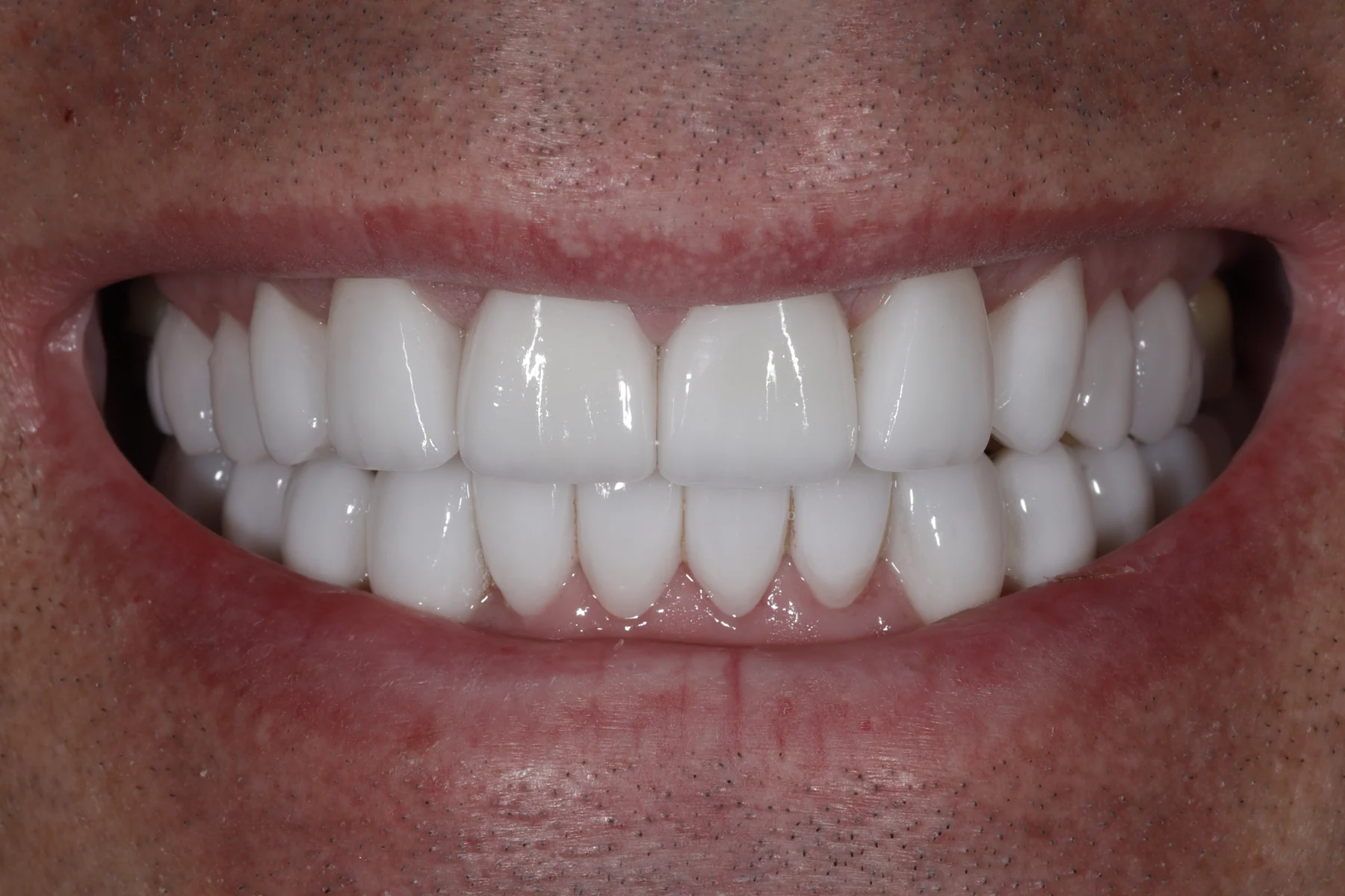 After porcelain smile makeover