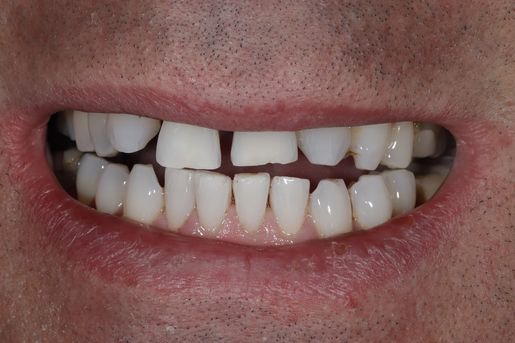 Before porcelain smile makeover