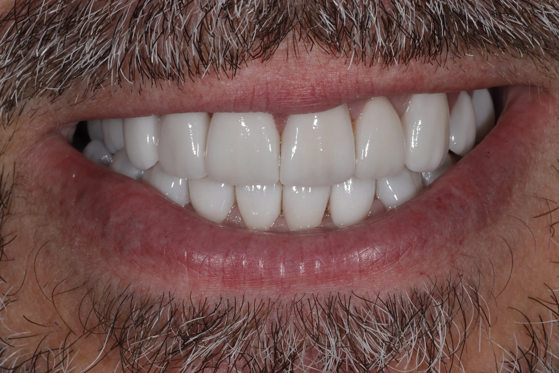 After porcelain veneer treatment
