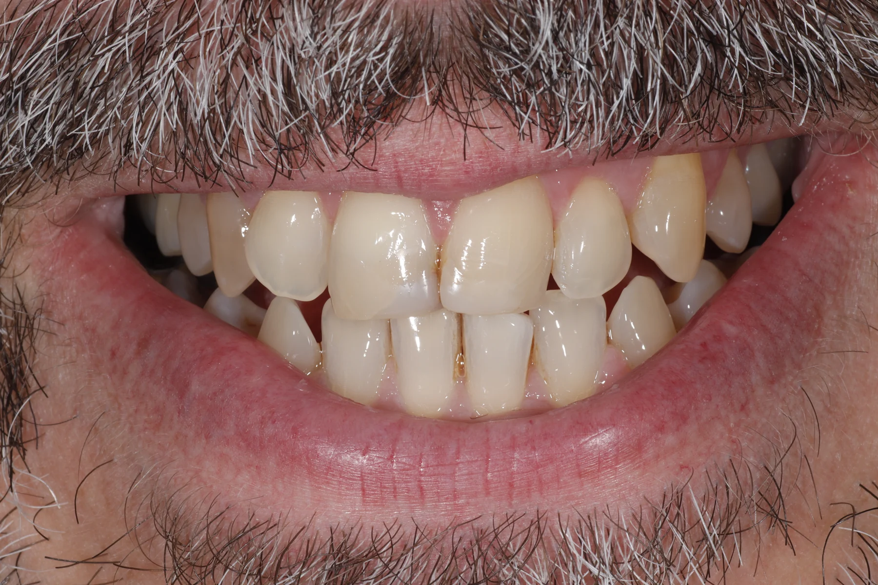 Before porcelain veneer treatment